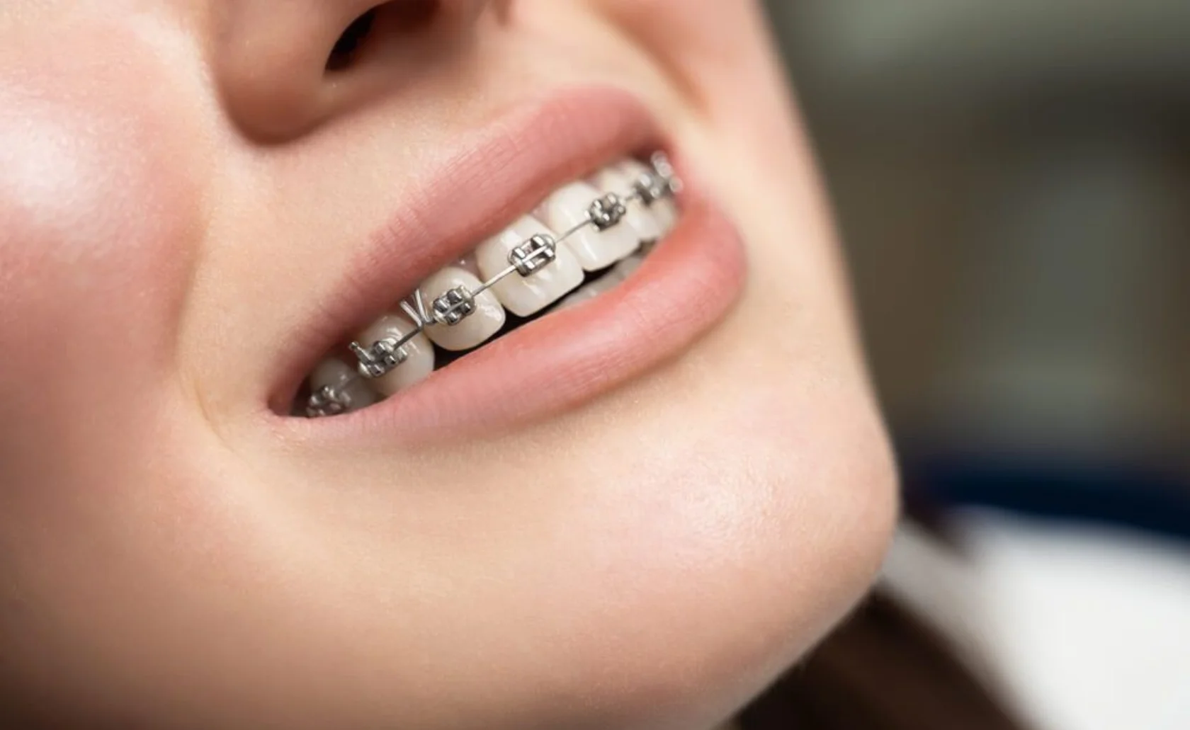 Orthodontics Treatment